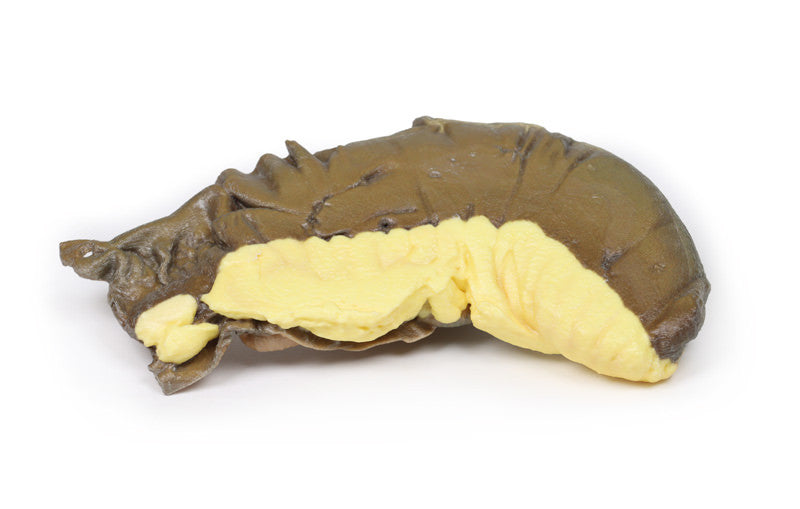Intussusception of small bowel due to metastatic tumour