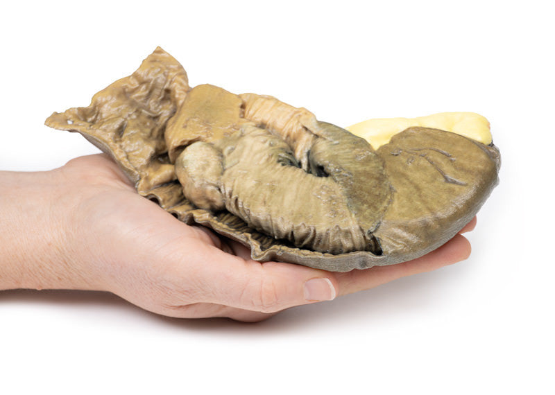 Intussusception of small bowel due to metastatic tumour