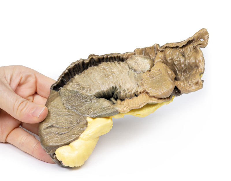 Intussusception of small bowel due to metastatic tumour