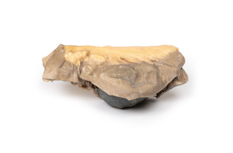 Gall Stone Ileus