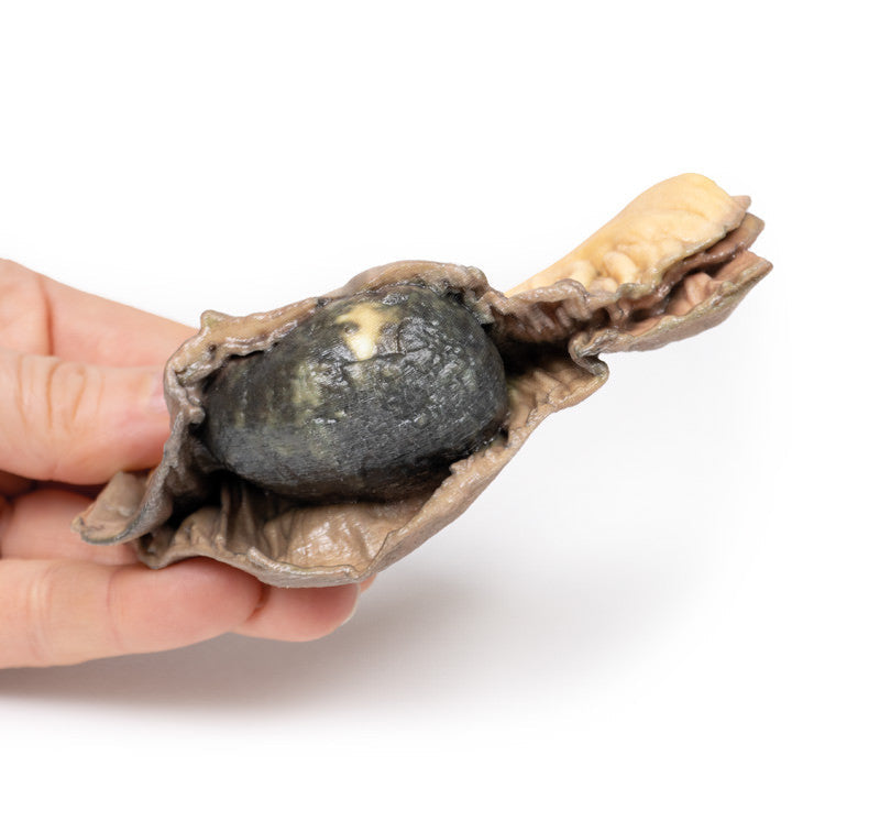 Gall Stone Ileus
