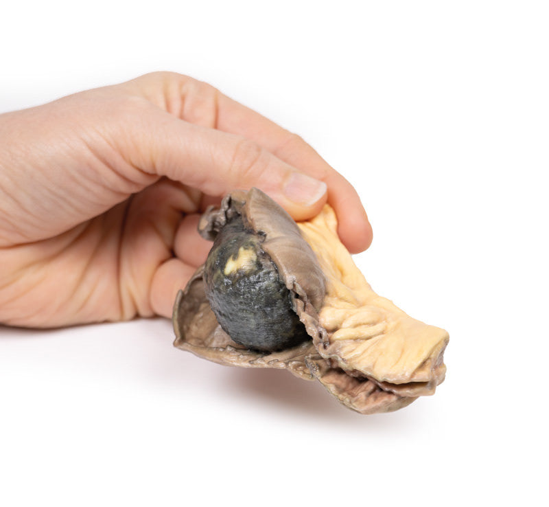 Gall Stone Ileus