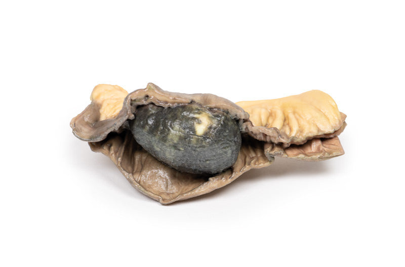 Gall Stone Ileus