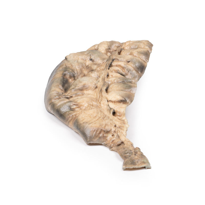 Hirschsprung's Disease