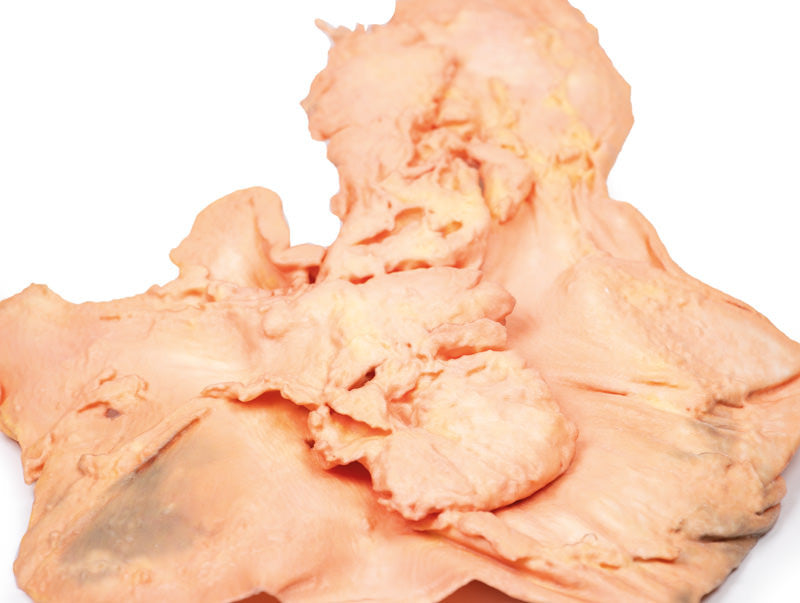 Adenocarcinoma of the stomach