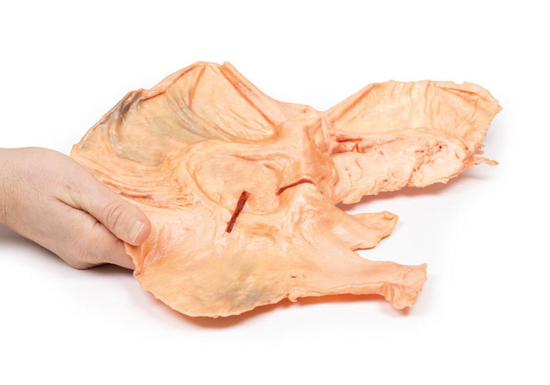Adenocarcinoma of the stomach