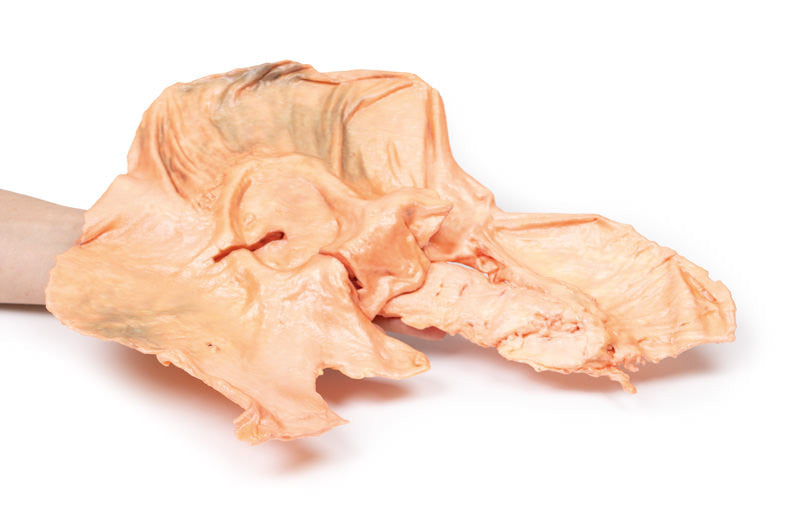 Adenocarcinoma of the stomach