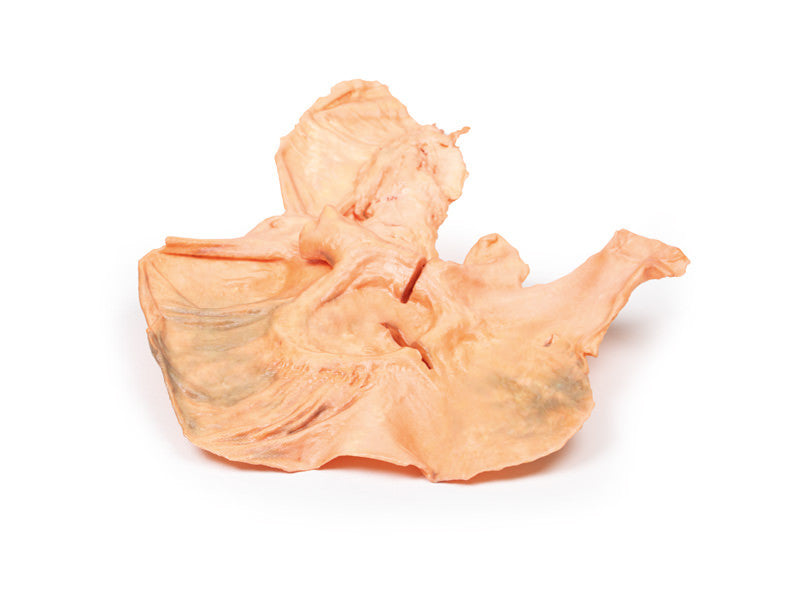 Adenocarcinoma of the stomach