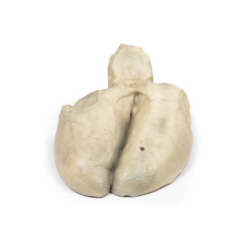 Cholecystitis and Cholelithiasis