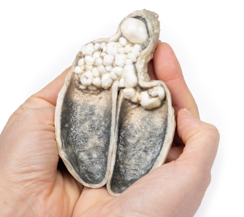 Cholecystitis and Cholelithiasis