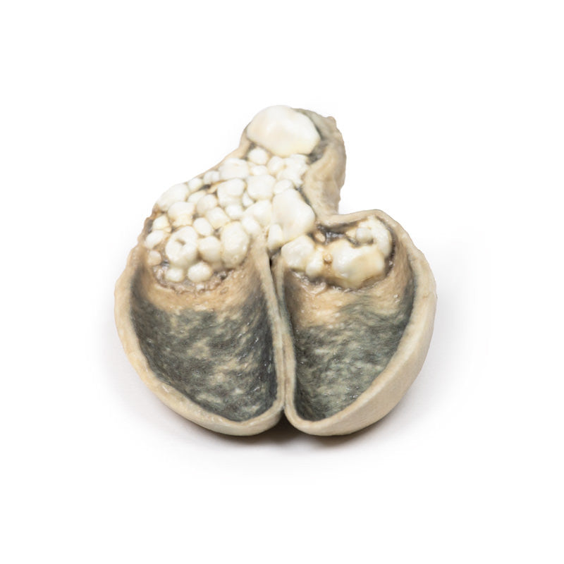 Cholecystitis and Cholelithiasis