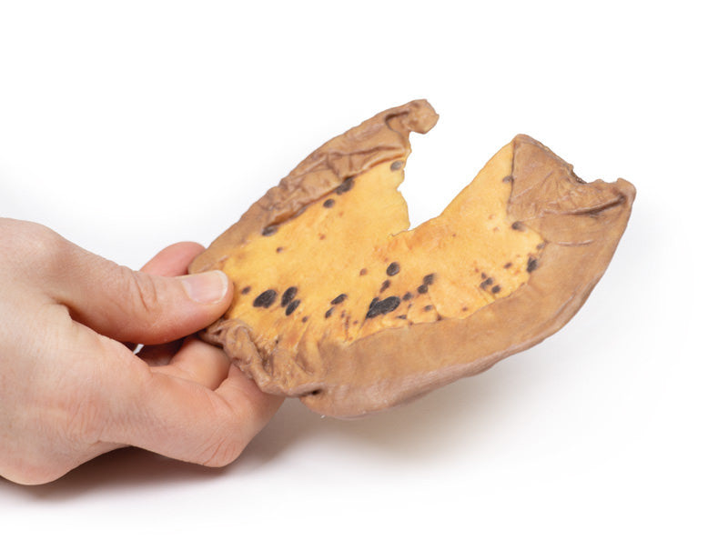 Mesenteric Metastases from Cutaneous Malignant Melanoma