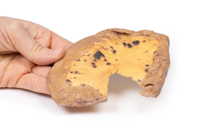 Mesenteric Metastases from Cutaneous Malignant Melanoma
