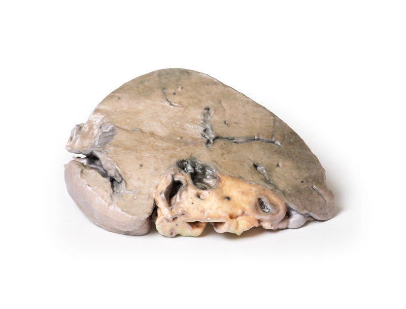Hepatic duct calculi and Obstructive Biliary Cirrhosis