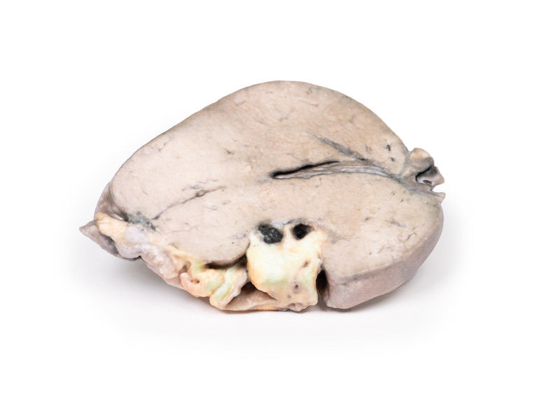 Hepatic duct calculi and Obstructive Biliary Cirrhosis