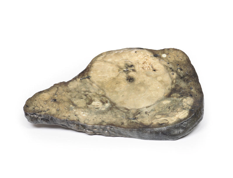 Hepatocellular Carcinoma