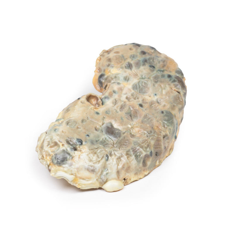 Adult polycystic kidney disease