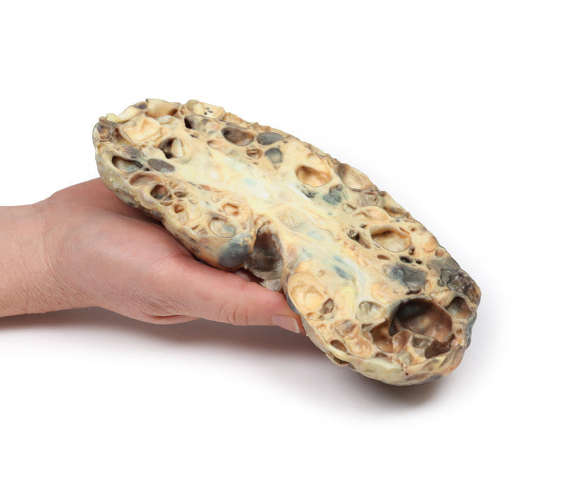 Adult polycystic kidney disease