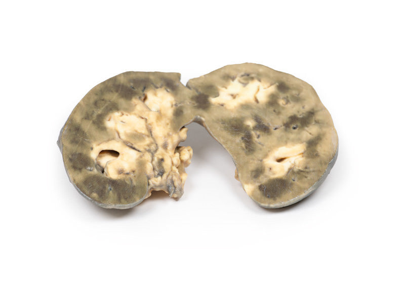 Horseshoe Kidney