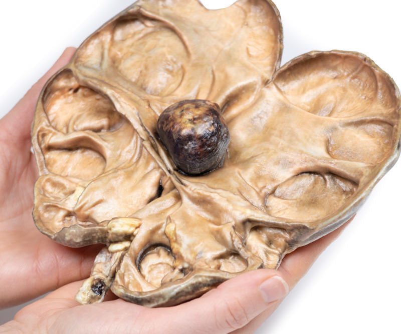 Hydronephrosis and Hydroureter Caused by Obstruction by a Renal Calculus