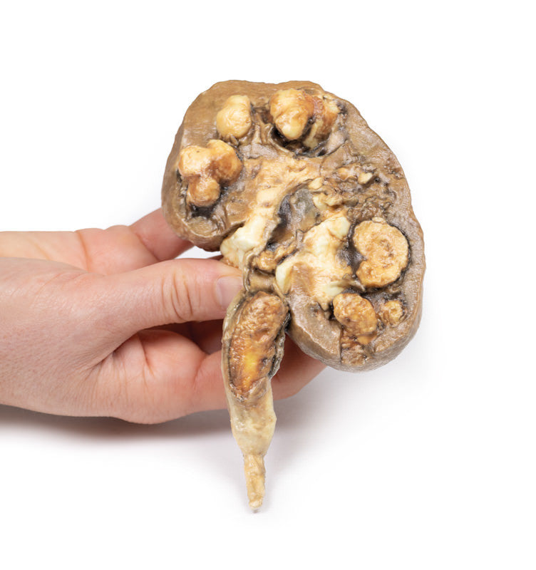 Multiple Renal Calculi