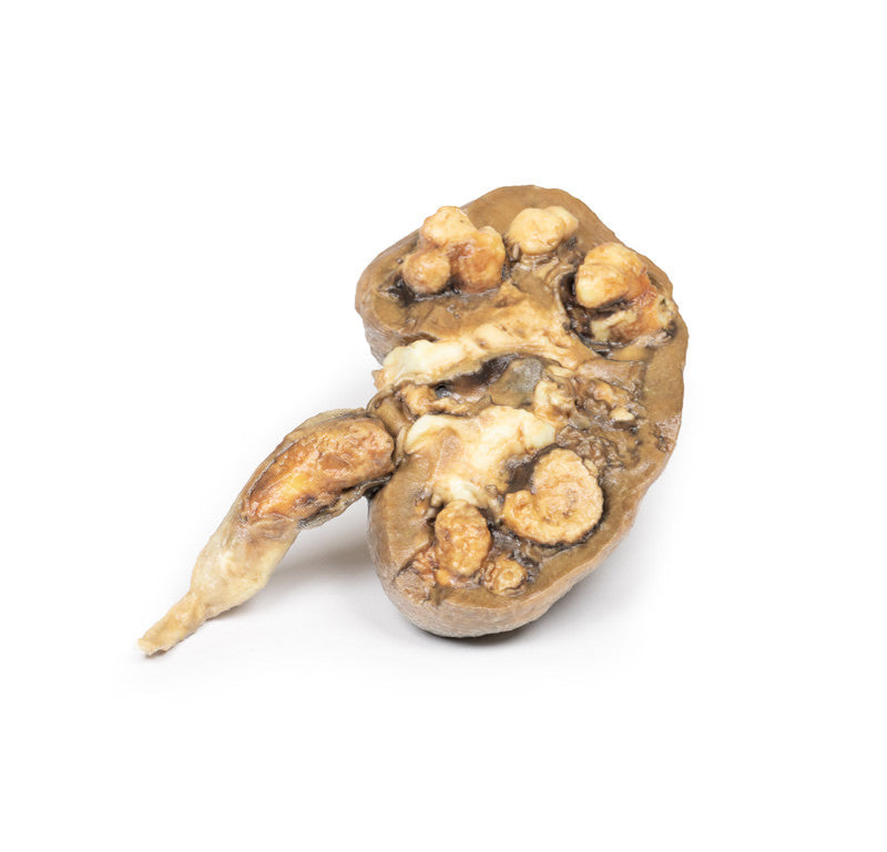 Multiple Renal Calculi