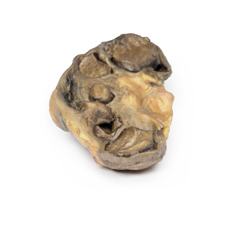 Pyonephrosis
