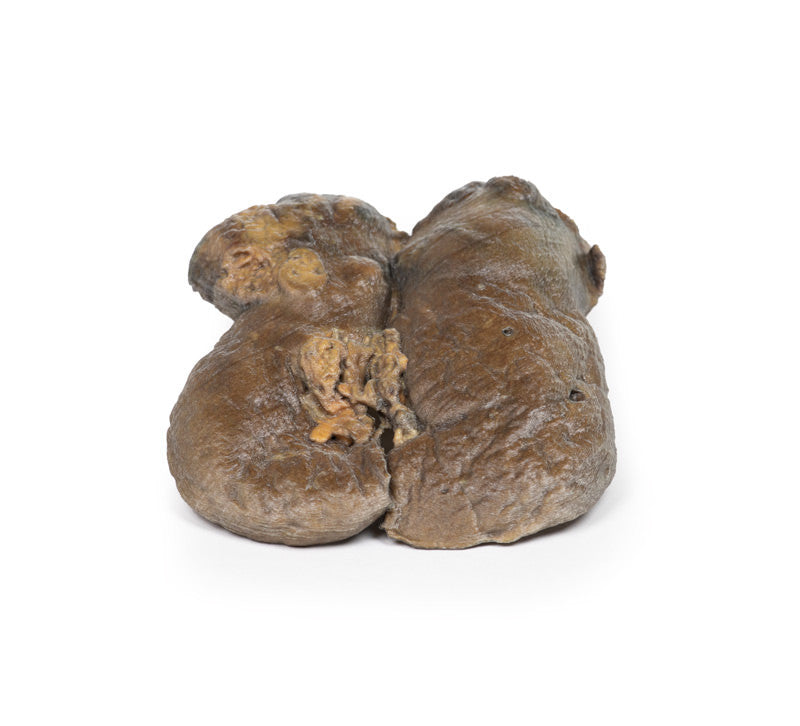 Renal Cell Carcinoma