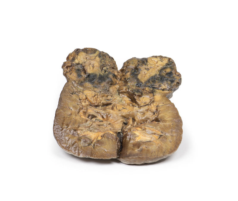 Renal Cell Carcinoma