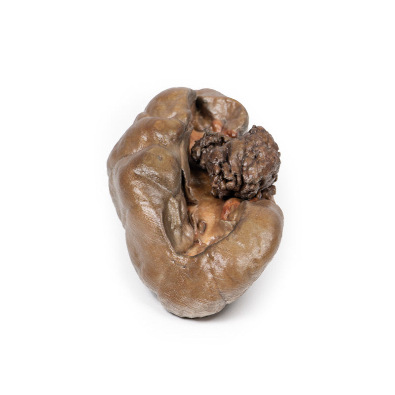 Papillary Transitional Cell Carcinoma of the Renal Pelvis
