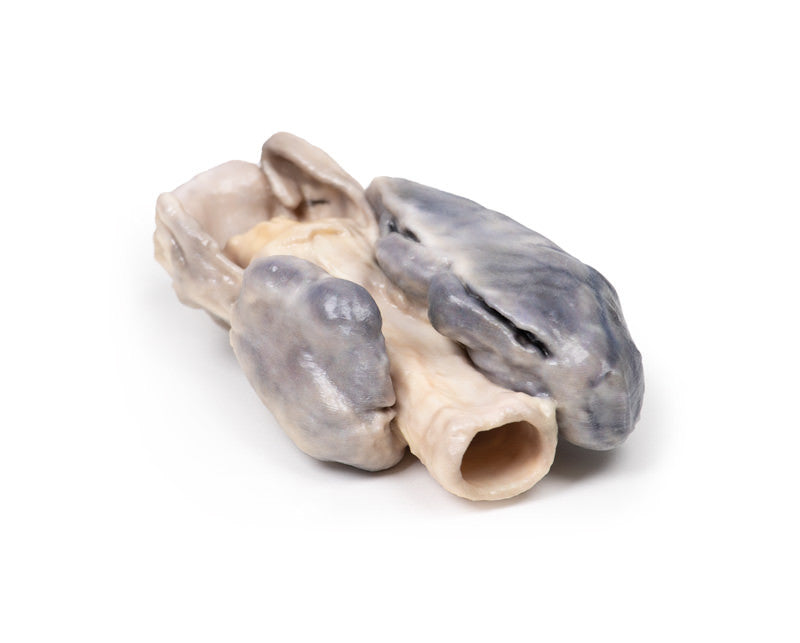 Retrosternal Goiter