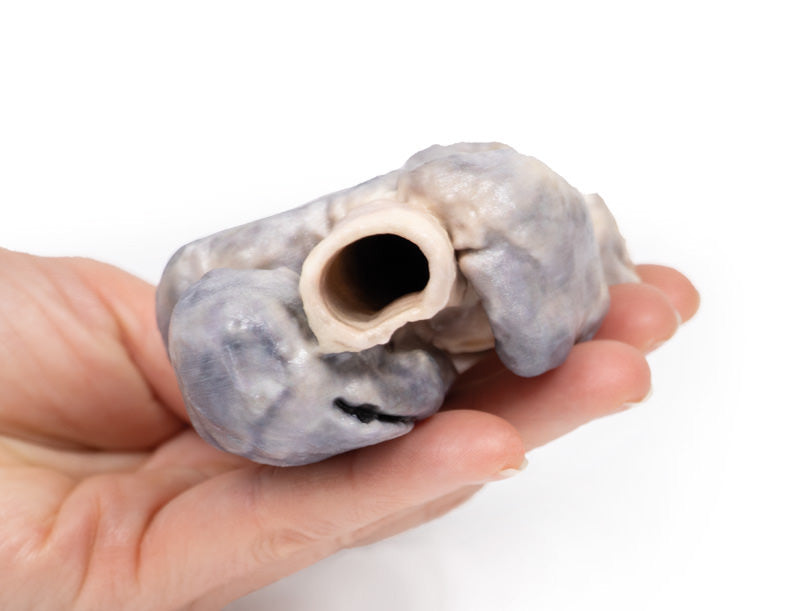 Retrosternal Goiter