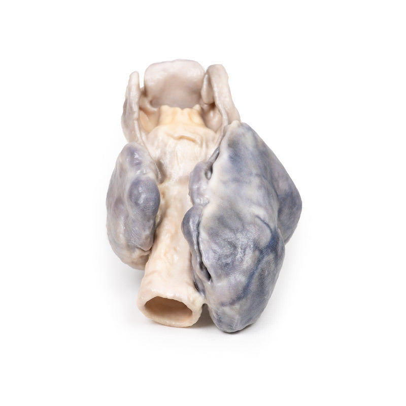 Retrosternal Goiter
