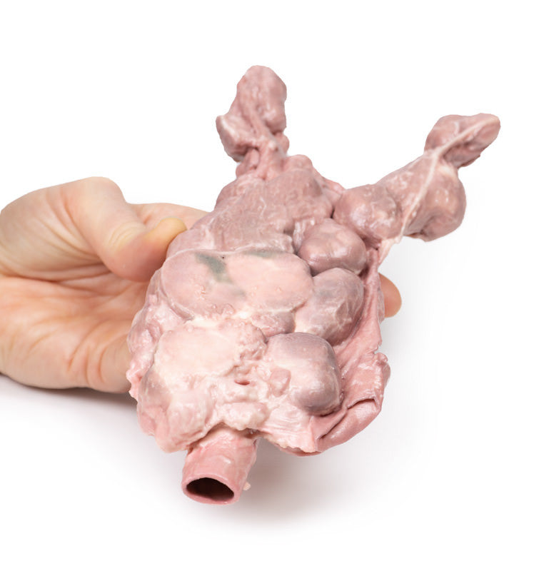 Aorta & para-aortic lymph nodes