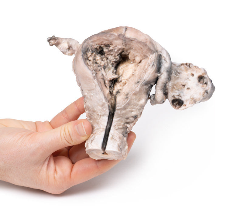 Endometrial Carcinoma
