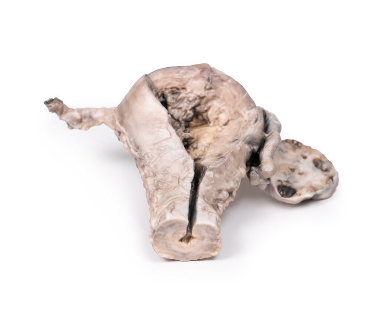 Endometrial Carcinoma