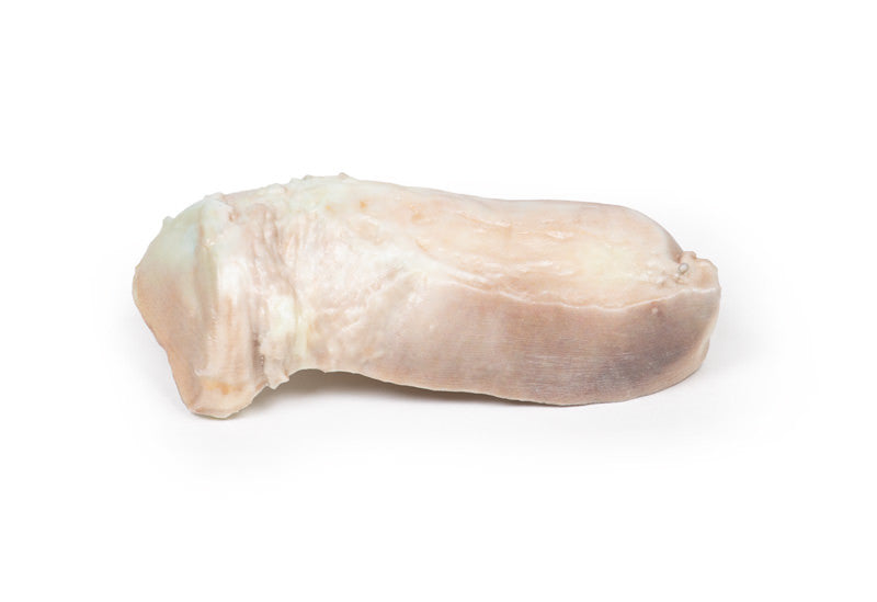 Uterine Leiomyoma