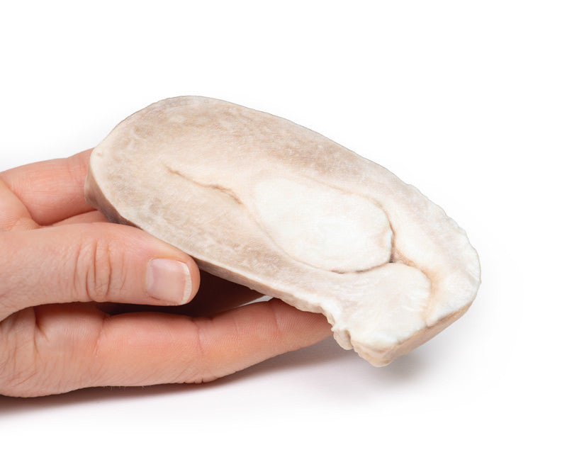Uterine Leiomyoma