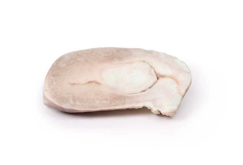 Uterine Leiomyoma