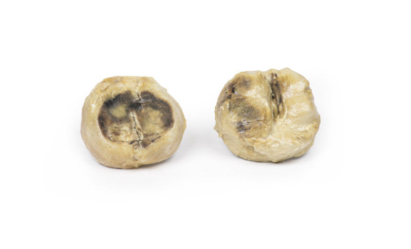 Nodular hyperplasia of the Prostate