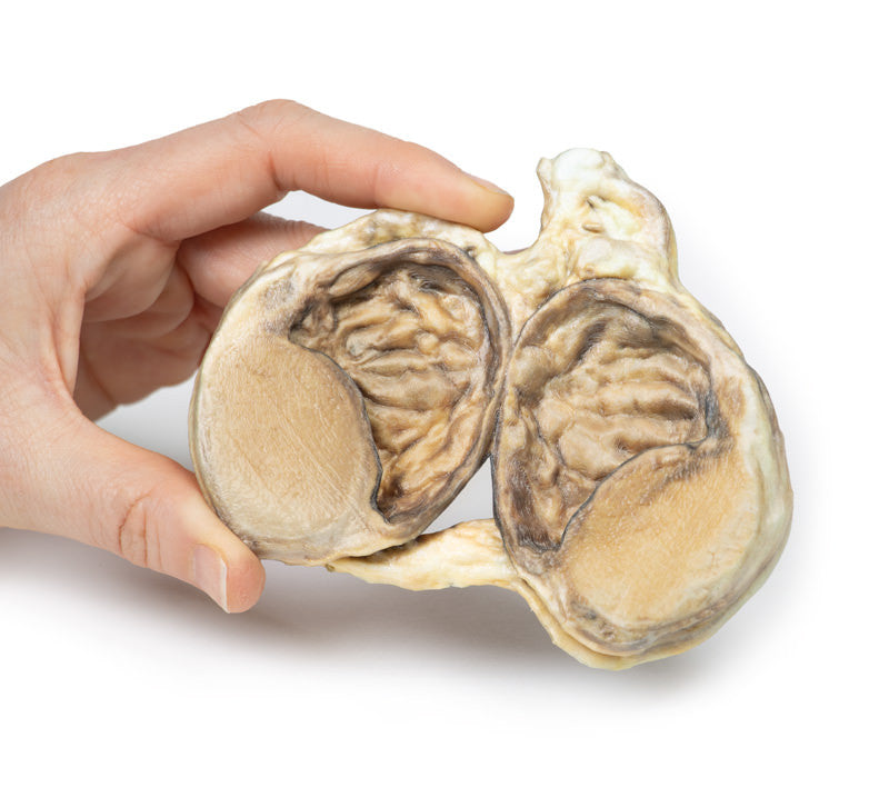 Chronic hydrocoele