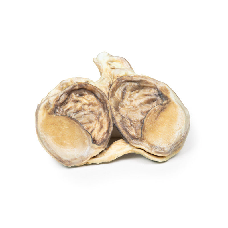 Chronic hydrocoele