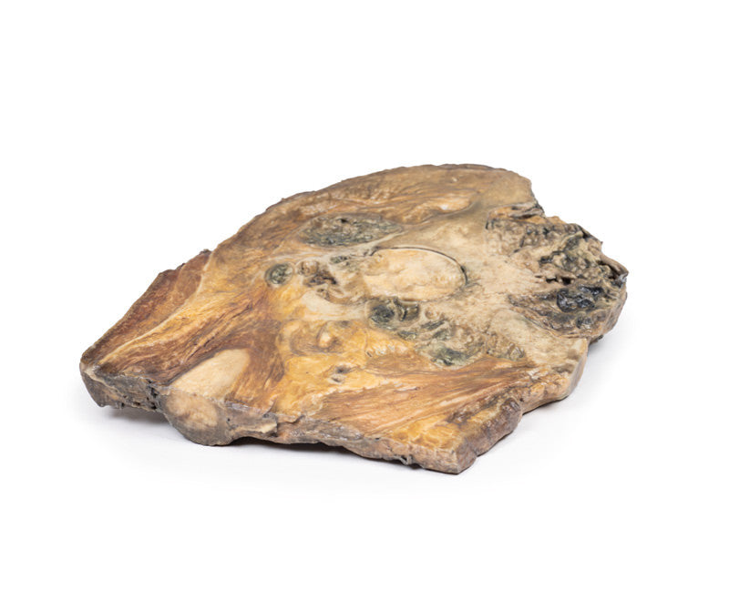Chondrosarcoma of femur and ilium