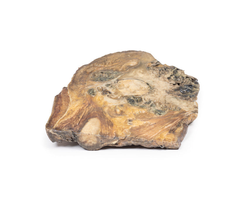 Chondrosarcoma of femur and ilium