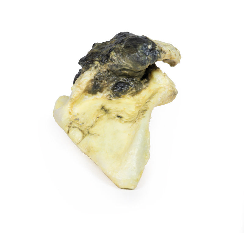 Chondrosarcoma of scapula