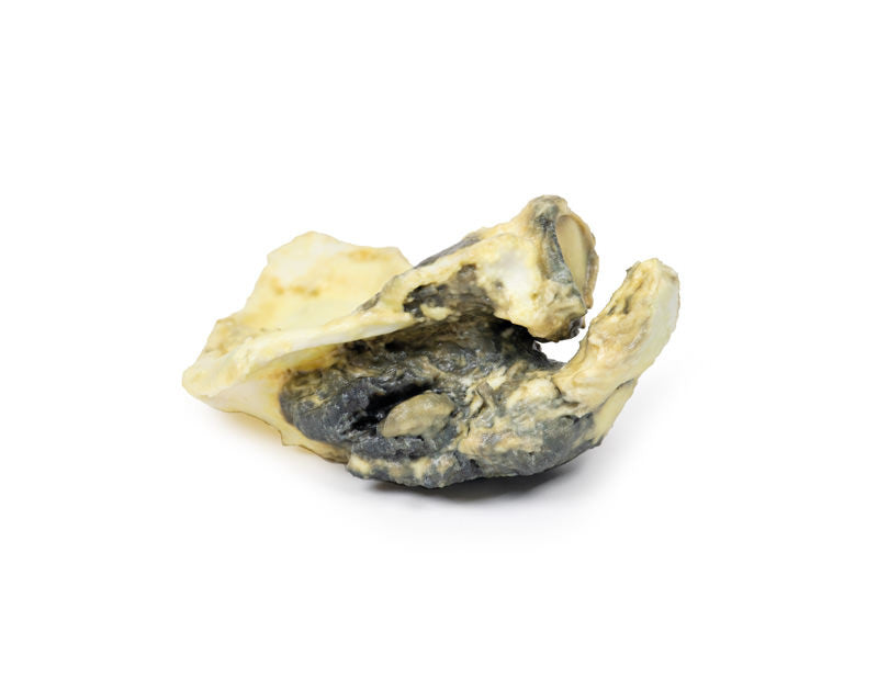 Chondrosarcoma of scapula