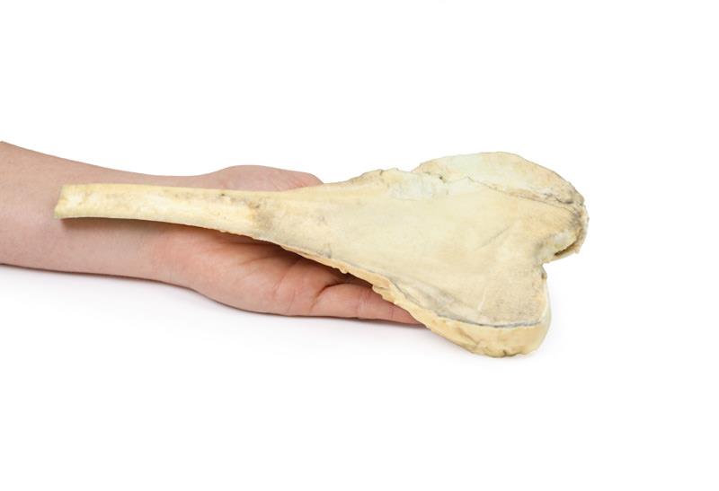 Osteosarcoma of femur