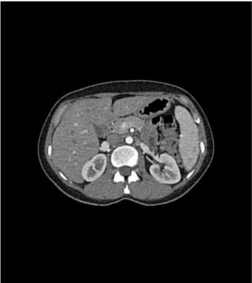 Abdomen phantom for CT, X-ray and radiation therapy