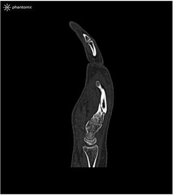 Hand phantom for CT, X-ray and radiation therapy