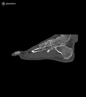 Foot phantom for CT, X-ray and radiation therapy